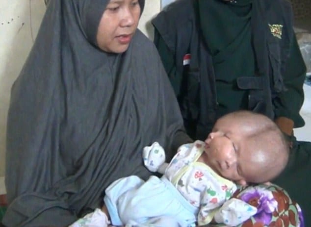 В Индонезии родился мальчик с двумя лицами